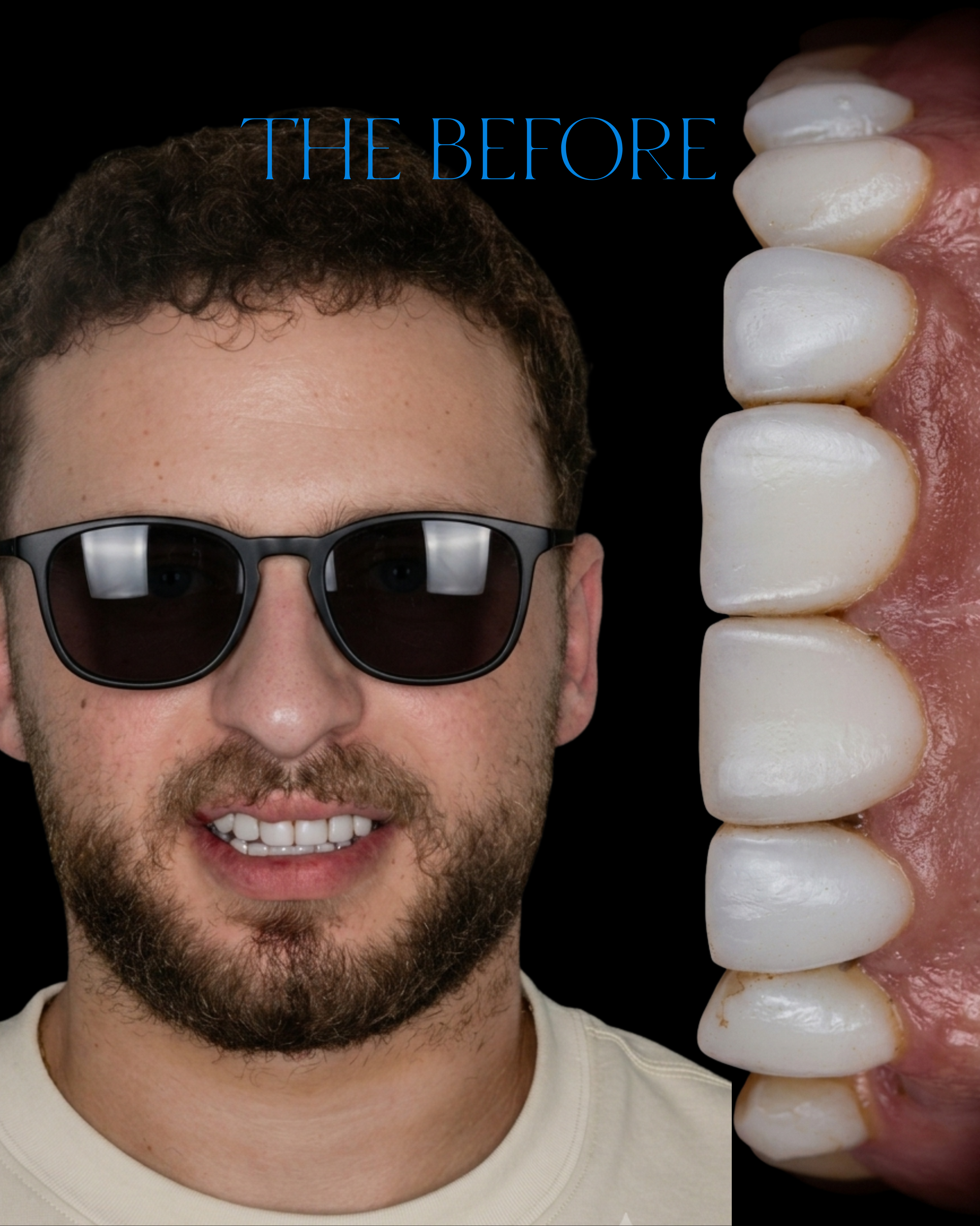 Veneers before