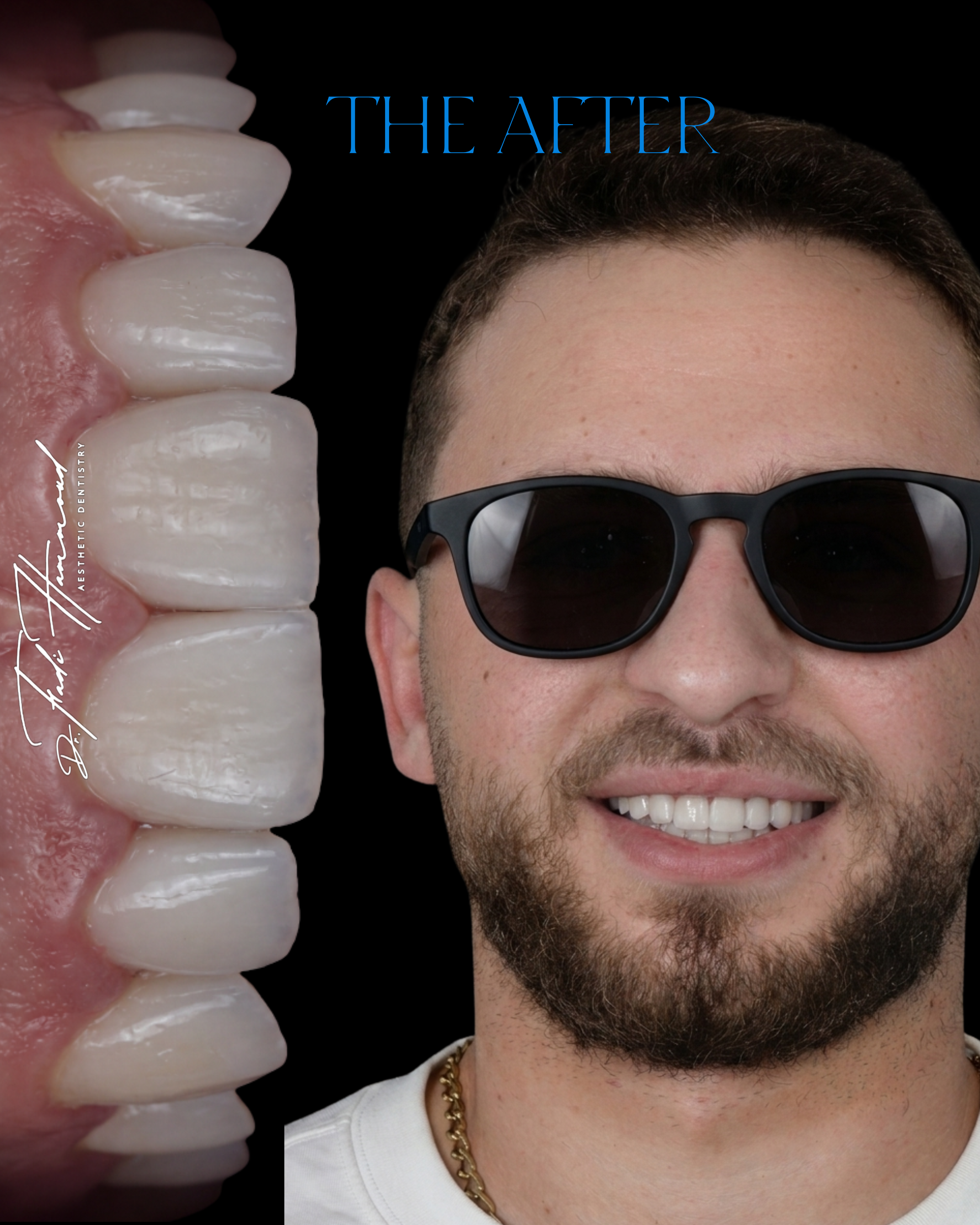 Veneers after