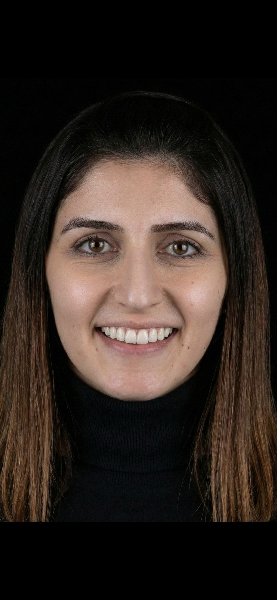 Natural Emax Veneers after