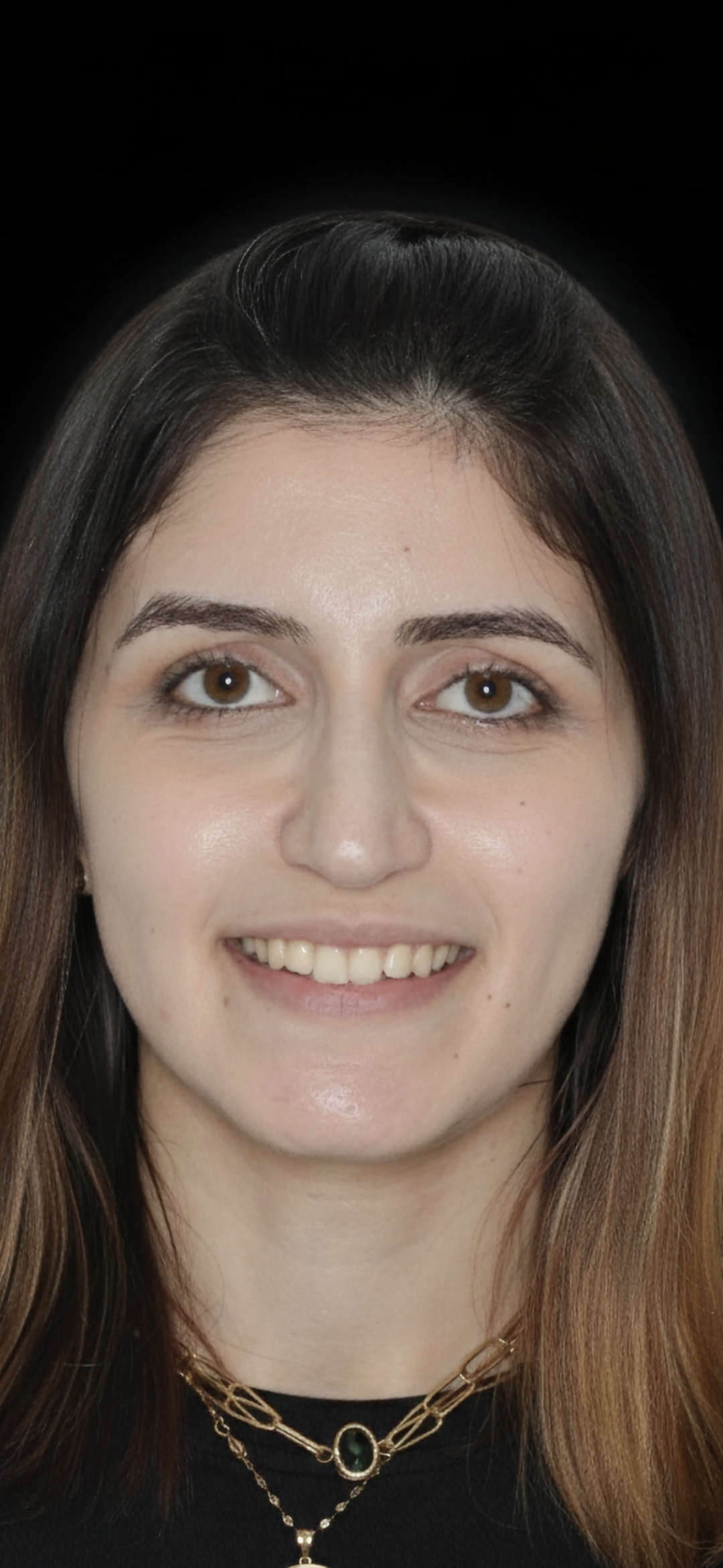 Natural Emax Veneers before