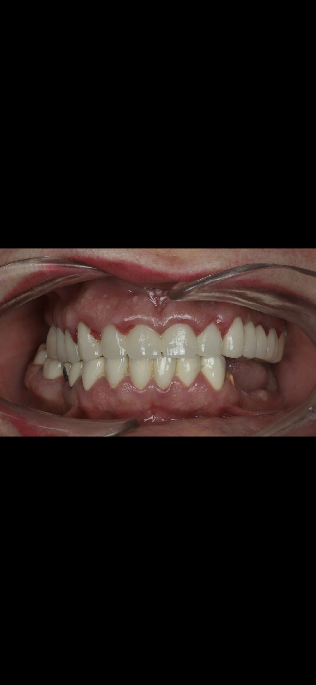 Zirconia Crowns before